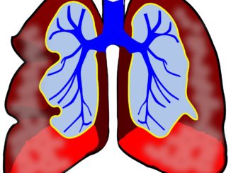 Asthma