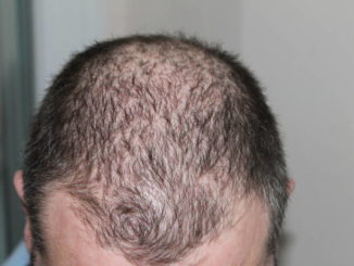 Men Lose Hair