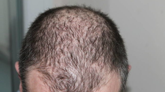 Men-Lose-Hair Men Lose Hair